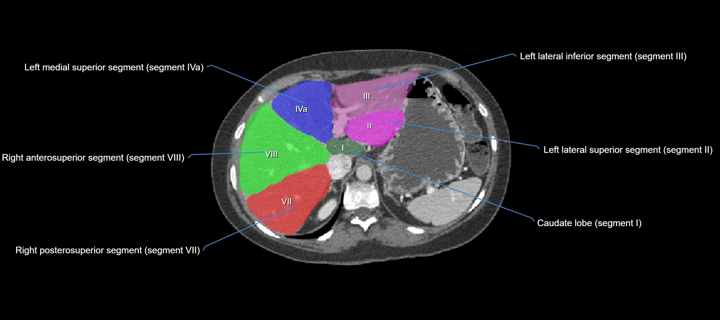 CT liver segments axial cross sectional anatomy labelled image-00052.webp